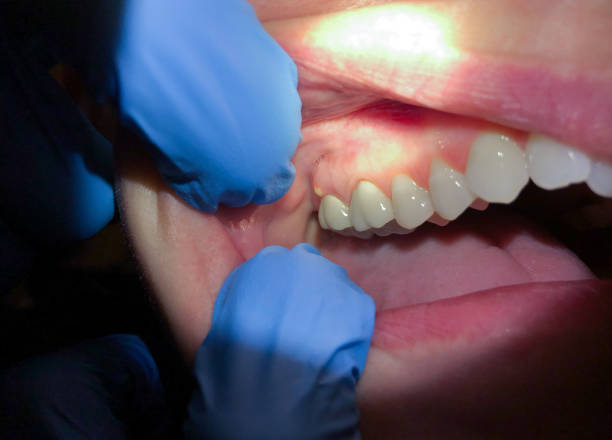 Best Emergency Tooth Extraction in Beachwood, NJ